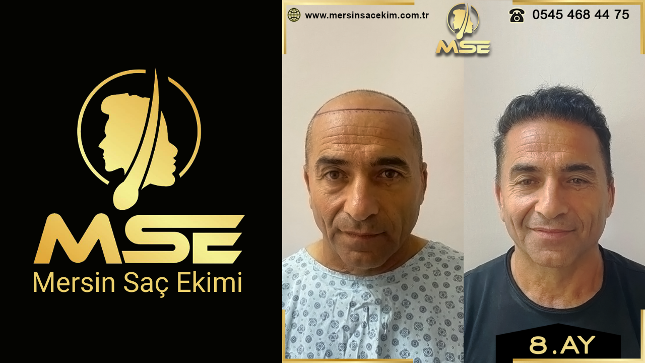 Mersin Saç Ekimi